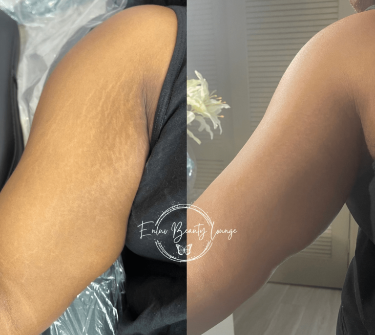 Ink-less Stretch Mark Rejuvenation (ISR)​