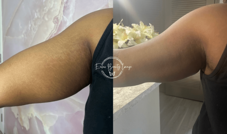 Ink-less Stretch Mark Rejuvenation (ISR)​