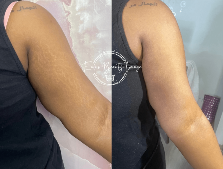 Ink-less Stretch Mark Rejuvenation (ISR)​