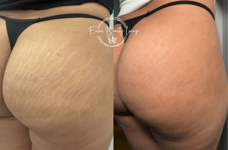 Ink-less Stretch Mark Rejuvenation (ISR)​