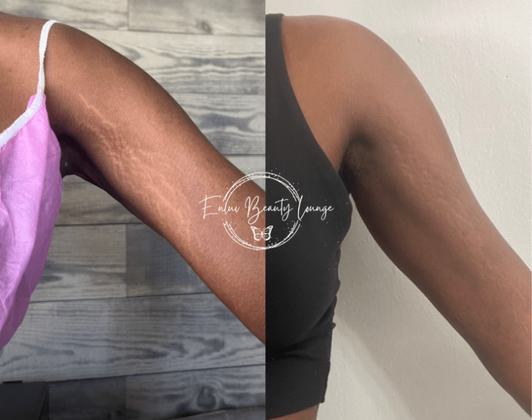 Ink-less Stretch Mark Rejuvenation (ISR)​