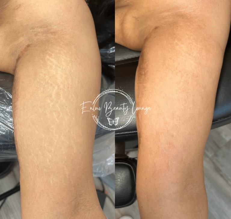 Ink-less Stretch Mark Rejuvenation (ISR)​