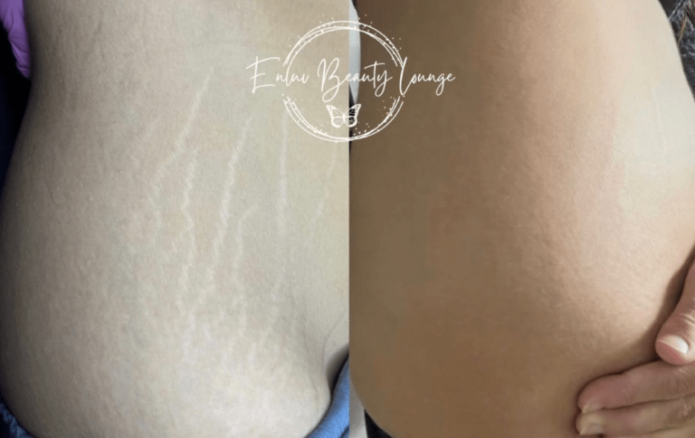 Ink-less Stretch Mark Rejuvenation (ISR)​