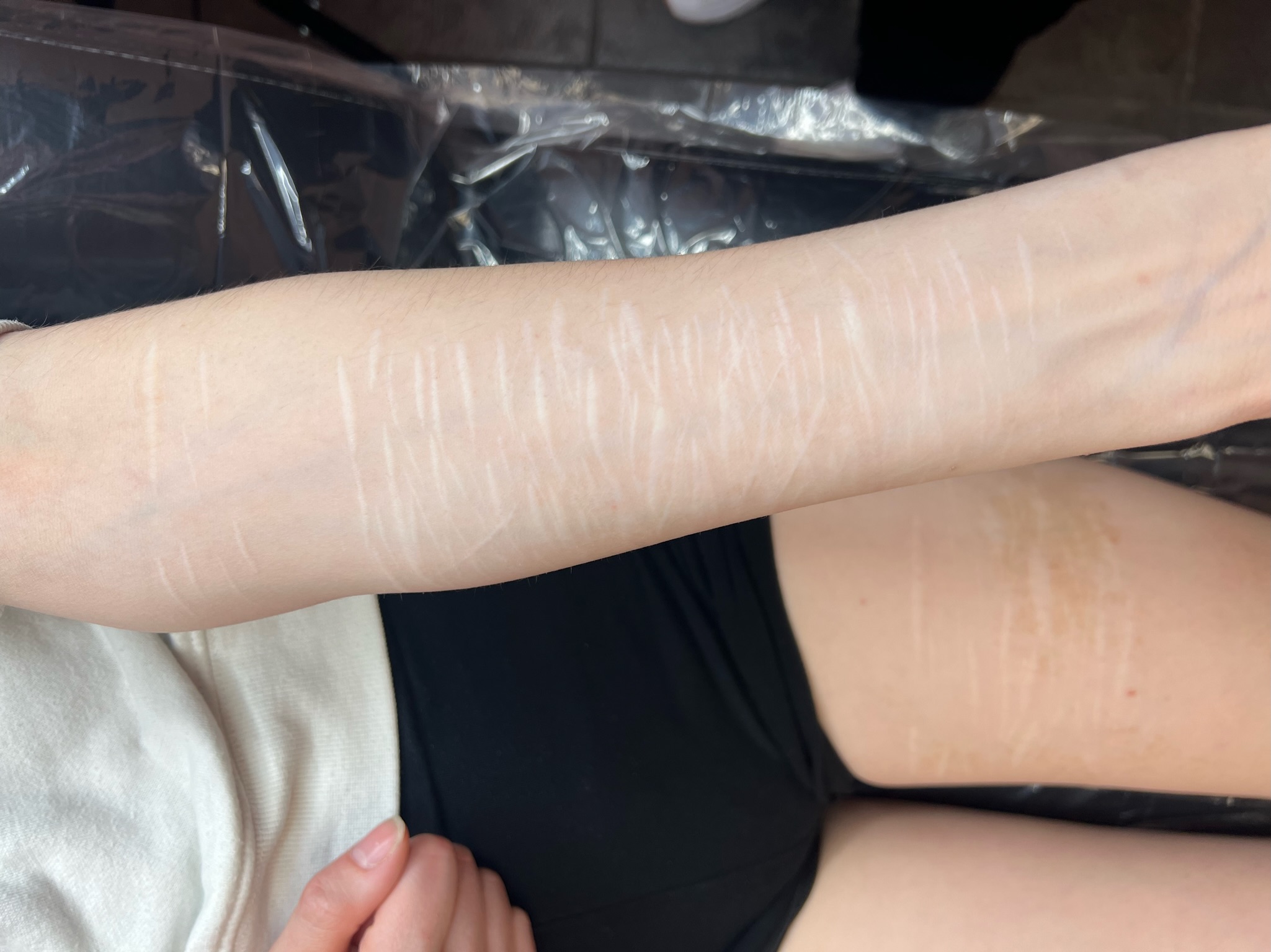 Can Paramedical Tattooing Help Camouflage Self-Harm Scars?
